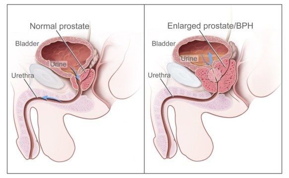 Rotes Maca Bei Prostatavergrosserung Dr Schweikart Verlag